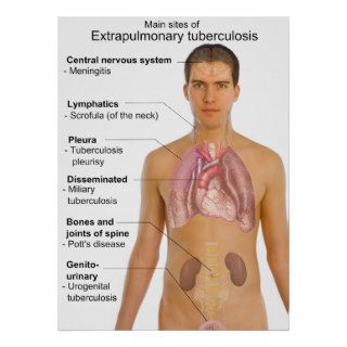 Main Symptoms of Extrapulmonary Tuberculosis Chart Posters