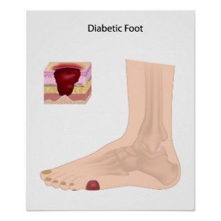 Diabetic Foot  Poster