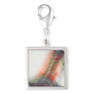 Osteoarthritis of neck, X ray Silver Square Charm by Admin_CP66866535