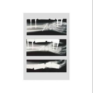 Arm with Implant X rayPrint (Canvas 24x36)